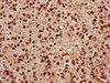 IHC image of CSB-PA716370LA01HU diluted at 1:800 and staining in paraffin-embedded human glioma performed on a Leica BondTM system. After dewaxing and hydration, antigen retrieval was mediated by high pressure in a citrate buffer (pH 6.0) . Section was blocked with 10% normal goat serum 30min at RT. Then primary antibody (1% BSA) was incubated at 4°C overnight. The primary is detected by a biotinylated secondary antibody and visualized using an HRP conjugated SP system. IHC image of CSB-PA716370LA01HU diluted at 1:800 and staining in paraffin-embedded human glioma performed on a Leica BondTM system. After dewaxing and hydration, antigen retrieval was mediated by high pressure in a citrate buffer (pH 6.0) . Section was blocked with 10% normal goat serum 30min at RT. Then primary antibody (1% BSA) was incubated at 4°C overnight. The primary is detected by a biotinylated secondary antibody and visualized using an HRP conjugated SP system.