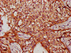 IHC image of CSB-PA735951LA01HU diluted at 1:300 and staining in paraffin-embedded human cervical cancer performed on a Leica BondTM system. After dewaxing and hydration, antigen retrieval was mediated by high pressure in a citrate buffer (pH 6.0) . Section was blocked with 10% normal goat serum 30min at RT. Then primary antibody (1% BSA) was incubated at 4°C overnight. The primary is detected by a biotinylated secondary antibody and visualized using an HRP conjugated SP system.