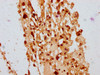 IHC image of CSB-PA889087LA01HU diluted at 1:400 and staining in paraffin-embedded human melanoma performed on a Leica BondTM system. After dewaxing and hydration, antigen retrieval was mediated by high pressure in a citrate buffer (pH 6.0) . Section was blocked with 10% normal goat serum 30min at RT. Then primary antibody (1% BSA) was incubated at 4°C overnight. The primary is detected by a biotinylated secondary antibody and visualized using an HRP conjugated SP system.