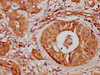 IHC image of CSB-PA896538LA01HU diluted at 1:300 and staining in paraffin-embedded human cervical cancer performed on a Leica BondTM system. After dewaxing and hydration, antigen retrieval was mediated by high pressure in a citrate buffer (pH 6.0) . Section was blocked with 10% normal goat serum 30min at RT. Then primary antibody (1% BSA) was incubated at 4°C overnight. The primary is detected by a biotinylated secondary antibody and visualized using an HRP conjugated SP system.