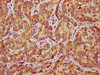 IHC image of CSB-PA896698LA01HU diluted at 1:500 and staining in paraffin-embedded human liver cancer performed on a Leica BondTM system. After dewaxing and hydration, antigen retrieval was mediated by high pressure in a citrate buffer (pH 6.0) . Section was blocked with 10% normal goat serum 30min at RT. Then primary antibody (1% BSA) was incubated at 4°C overnight. The primary is detected by a biotinylated secondary antibody and visualized using an HRP conjugated SP system.