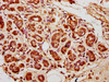 IHC image of CSB-PA010418OA04nbhbHU diluted at 1:10 and staining in paraffin-embedded human breast cancer performed on a Leica BondTM system. After dewaxing and hydration, antigen retrieval was mediated by high pressure in a citrate buffer (pH 6.0) . Section was blocked with 10% normal goat serum 30min at RT. Then primary antibody (1% BSA) was incubated at 4°C overnight. The primary is detected by a biotinylated secondary antibody and visualized using an HRP conjugated SP system.
