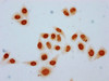 Immunocytochemistry analysis of CSB-PA010418OA09crHU diluted at 1:100 and staining in Hela cells (treated with 30mM sodium crotonylate for 4h) performed on a Leica BondTM system. The cells were fixed in 4% formaldehyde, permeabilized using 0.2% Triton X-100 and blocked with 10% normal goat serum 30min at RT. Then primary antibody (1% BSA) was incubated at 4°C overnight. The primary is detected by a biotinylated secondary antibody and visualized using an HRP conjugated SP system.