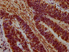 IHC image of CSB-PA010378OA45nme1HU diluted at 1:20 and staining in paraffin-embedded human ovarian cancer performed on a Leica BondTM system. After dewaxing and hydration, antigen retrieval was mediated by high pressure in a citrate buffer (pH 6.0) . Section was blocked with 10% normal goat serum 30min at RT. Then primary antibody (1% BSA) was incubated at 4°C overnight. The primary is detected by a biotinylated secondary antibody and visualized using an HRP conjugated SP system.
