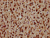 IHC image of CSB-PA010378OA45nme1HU diluted at 1:20 and staining in paraffin-embedded human glioma performed on a Leica BondTM system. After dewaxing and hydration, antigen retrieval was mediated by high pressure in a citrate buffer (pH 6.0) . Section was blocked with 10% normal goat serum 30min at RT. Then primary antibody (1% BSA) was incubated at 4°C overnight. The primary is detected by a biotinylated secondary antibody and visualized using an HRP conjugated SP system.
