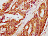 IHC image of CSB-PA004729LA01HU diluted at 1:300 and staining in paraffin-embedded human colon cancer performed on a Leica BondTM system. After dewaxing and hydration, antigen retrieval was mediated by high pressure in a citrate buffer (pH 6.0) . Section was blocked with 10% normal goat serum 30min at RT. Then primary antibody (1% BSA) was incubated at 4°C overnight. The primary is detected by a biotinylated secondary antibody and visualized using an HRP conjugated SP system.
