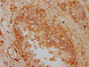 IHC image of CSB-PA008075LA01HU diluted at 1:300 and staining in paraffin-embedded human prostate cancer performed on a Leica BondTM system. After dewaxing and hydration, antigen retrieval was mediated by high pressure in a citrate buffer (pH 6.0) . Section was blocked with 10% normal goat serum 30min at RT. Then primary antibody (1% BSA) was incubated at 4°C overnight. The primary is detected by a biotinylated secondary antibody and visualized using an HRP conjugated SP system.