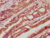 IHC image of CSB-PA012906LA01HU diluted at 1:400 and staining in paraffin-embedded human colon cancer performed on a Leica BondTM system. After dewaxing and hydration, antigen retrieval was mediated by high pressure in a citrate buffer (pH 6.0) . Section was blocked with 10% normal goat serum 30min at RT. Then primary antibody (1% BSA) was incubated at 4°C overnight. The primary is detected by a biotinylated secondary antibody and visualized using an HRP conjugated SP system.