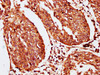 IHC image of CSB-PA021070LA01HU diluted at 1:200 and staining in paraffin-embedded human cervical cancer performed on a Leica BondTM system. After dewaxing and hydration, antigen retrieval was mediated by high pressure in a citrate buffer (pH 6.0) . Section was blocked with 10% normal goat serum 30min at RT. Then primary antibody (1% BSA) was incubated at 4°C overnight. The primary is detected by a biotinylated secondary antibody and visualized using an HRP conjugated SP system.