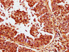 IHC image of CSB-PA23399A0Rb diluted at 1:400 and staining in paraffin-embedded human cervical cancer performed on a Leica BondTM system. After dewaxing and hydration, antigen retrieval was mediated by high pressure in a citrate buffer (pH 6.0) . Section was blocked with 10% normal goat serum 30min at RT. Then primary antibody (1% BSA) was incubated at 4°C overnight. The primary is detected by a biotinylated secondary antibody and visualized using an HRP conjugated SP system.
