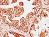 IHC image of CSB-PA622689LA01HU diluted at 1:200 and staining in paraffin-embedded human prostate cancer performed on a Leica BondTM system. After dewaxing and hydration, antigen retrieval was mediated by high pressure in a citrate buffer (pH 6.0) . Section was blocked with 10% normal goat serum 30min at RT. Then primary antibody (1% BSA) was incubated at 4°C overnight. The primary is detected by a biotinylated secondary antibody and visualized using an HRP conjugated SP system.