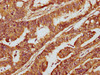 IHC image of CSB-PA715035LA01HU diluted at 1:300 and staining in paraffin-embedded human colon cancer performed on a Leica BondTM system. After dewaxing and hydration, antigen retrieval was mediated by high pressure in a citrate buffer (pH 6.0) . Section was blocked with 10% normal goat serum 30min at RT. Then primary antibody (1% BSA) was incubated at 4°C overnight. The primary is detected by a biotinylated secondary antibody and visualized using an HRP conjugated SP system.