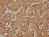 IHC image of CSB-PA856440LA01HU diluted at 1:500 and staining in paraffin-embedded human liver cancer performed on a Leica BondTM system. After dewaxing and hydration, antigen retrieval was mediated by high pressure in a citrate buffer (pH 6.0) . Section was blocked with 10% normal goat serum 30min at RT. Then primary antibody (1% BSA) was incubated at 4°C overnight. The primary is detected by a biotinylated secondary antibody and visualized using an HRP conjugated SP system.