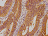 IHC image of CSB-PA018904OA01HU diluted at 1:100 and staining in paraffin-embedded human colon cancer performed on a Leica BondTM system. After dewaxing and hydration, antigen retrieval was mediated by high pressure in a citrate buffer (pH 6.0) . Section was blocked with 10% normal goat serum 30min at RT. Then primary antibody (1% BSA) was incubated at 4°C overnight. The primary is detected by a biotinylated secondary antibody and visualized using an HRP conjugated SP system.