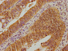 IHC image of CSB-PA025468OA01HU diluted at 1:100 and staining in paraffin-embedded human colon cancer performed on a Leica BondTM system. After dewaxing and hydration, antigen retrieval was mediated by high pressure in a citrate buffer (pH 6.0) . Section was blocked with 10% normal goat serum 30min at RT. Then primary antibody (1% BSA) was incubated at 4°C overnight. The primary is detected by a biotinylated secondary antibody and visualized using an HRP conjugated SP system.