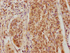IHC image of CSB-PA086427LA01HU diluted at 1:400 and staining in paraffin-embedded human cervical cancer performed on a Leica BondTM system. After dewaxing and hydration, antigen retrieval was mediated by high pressure in a citrate buffer (pH 6.0) . Section was blocked with 10% normal goat serum 30min at RT. Then primary antibody (1% BSA) was incubated at 4°C overnight. The primary is detected by a biotinylated secondary antibody and visualized using an HRP conjugated SP system.