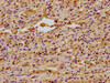IHC image of CSB-PA836207LA01HU diluted at 1:400 and staining in paraffin-embedded human lung cancer performed on a Leica BondTM system. After dewaxing and hydration, antigen retrieval was mediated by high pressure in a citrate buffer (pH 6.0) . Section was blocked with 10% normal goat serum 30min at RT. Then primary antibody (1% BSA) was incubated at 4°C overnight. The primary is detected by a biotinylated secondary antibody and visualized using an HRP conjugated SP system.