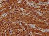 IHC image of CSB-PA020350LA01HU diluted at 1:400 and staining in paraffin-embedded human ovarian cancer performed on a Leica BondTM system. After dewaxing and hydration, antigen retrieval was mediated by high pressure in a citrate buffer (pH 6.0) . Section was blocked with 10% normal goat serum 30min at RT. Then primary antibody (1% BSA) was incubated at 4°C overnight. The primary is detected by a biotinylated secondary antibody and visualized using an HRP conjugated SP system.