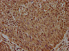 IHC image of CSB-PA860357EA01HU diluted at 1:300 and staining in paraffin-embedded human cervical cancer performed on a Leica BondTM system. After dewaxing and hydration, antigen retrieval was mediated by high pressure in a citrate buffer (pH 6.0) . Section was blocked with 10% normal goat serum 30min at RT. Then primary antibody (1% BSA) was incubated at 4°C overnight. The primary is detected by a biotinylated secondary antibody and visualized using an HRP conjugated SP system.