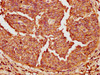 IHC image of CSB-PA007761LA01HU diluted at 1:200 and staining in paraffin-embedded human cervical cancer performed on a Leica BondTM system. After dewaxing and hydration, antigen retrieval was mediated by high pressure in a citrate buffer (pH 6.0) . Section was blocked with 10% normal goat serum 30min at RT. Then primary antibody (1% BSA) was incubated at 4°C overnight. The primary is detected by a biotinylated secondary antibody and visualized using an HRP conjugated SP system.
