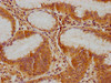 IHC image of CSB-PA011041NA01HU diluted at 1:100 and staining in paraffin-embedded human gastric cancer performed on a Leica BondTM system. After dewaxing and hydration, antigen retrieval was mediated by high pressure in a citrate buffer (pH 6.0) . Section was blocked with 10% normal goat serum 30min at RT. Then primary antibody (1% BSA) was incubated at 4°C overnight. The primary is detected by a biotinylated secondary antibody and visualized using an HRP conjugated SP system.