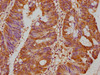 IHC image of CSB-PA017647LA01HU diluted at 1:500 and staining in paraffin-embedded human colon cancer performed on a Leica BondTM system. After dewaxing and hydration, antigen retrieval was mediated by high pressure in a citrate buffer (pH 6.0) . Section was blocked with 10% normal goat serum 30min at RT. Then primary antibody (1% BSA) was incubated at 4°C overnight. The primary is detected by a biotinylated secondary antibody and visualized using an HRP conjugated SP system.