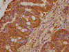 IHC image of CSB-PA018613LA01HU diluted at 1:400 and staining in paraffin-embedded human colon cancer performed on a Leica BondTM system. After dewaxing and hydration, antigen retrieval was mediated by high pressure in a citrate buffer (pH 6.0) . Section was blocked with 10% normal goat serum 30min at RT. Then primary antibody (1% BSA) was incubated at 4°C overnight. The primary is detected by a biotinylated secondary antibody and visualized using an HRP conjugated SP system.