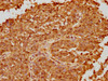 IHC image of CSB-PA018886LA01HU diluted at 1:100 and staining in paraffin-embedded human cervical cancer performed on a Leica BondTM system. After dewaxing and hydration, antigen retrieval was mediated by high pressure in a citrate buffer (pH 6.0) . Section was blocked with 10% normal goat serum 30min at RT. Then primary antibody (1% BSA) was incubated at 4°C overnight. The primary is detected by a biotinylated secondary antibody and visualized using an HRP conjugated SP system.