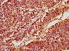 IHC image of CSB-PA837451LA01HU diluted at 1:200 and staining in paraffin-embedded human lung cancer performed on a Leica BondTM system. After dewaxing and hydration, antigen retrieval was mediated by high pressure in a citrate buffer (pH 6.0) . Section was blocked with 10% normal goat serum 30min at RT. Then primary antibody (1% BSA) was incubated at 4°C overnight. The primary is detected by a biotinylated secondary antibody and visualized using an HRP conjugated SP system.