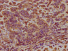 IHC image of CSB-PA007512LA01HU diluted at 1:300 and staining in paraffin-embedded human ovarian cancer performed on a Leica BondTM system. After dewaxing and hydration, antigen retrieval was mediated by high pressure in a citrate buffer (pH 6.0) . Section was blocked with 10% normal goat serum 30min at RT. Then primary antibody (1% BSA) was incubated at 4°C overnight. The primary is detected by a biotinylated secondary antibody and visualized using an HRP conjugated SP system. IHC image of CSB-PA007512LA01HU diluted at 1:300 and staining in paraffin-embedded human ovarian cancer performed on a Leica BondTM system. After dewaxing and hydration, antigen retrieval was mediated by high pressure in a citrate buffer (pH 6.0) . Section was blocked with 10% normal goat serum 30min at RT. Then primary antibody (1% BSA) was incubated at 4°C overnight. The primary is detected by a biotinylated secondary antibody and visualized using an HRP conjugated SP system.