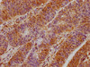 IHC image of CSB-PA662139LA01HU diluted at 1:400 and staining in paraffin-embedded human colon cancer performed on a Leica BondTM system. After dewaxing and hydration, antigen retrieval was mediated by high pressure in a citrate buffer (pH 6.0) . Section was blocked with 10% normal goat serum 30min at RT. Then primary antibody (1% BSA) was incubated at 4°C overnight. The primary is detected by a biotinylated secondary antibody and visualized using an HRP conjugated SP system.