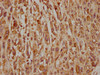 IHC image of CSB-PA001898LA01HU diluted at 1:320 and staining in paraffin-embedded human melanoma cancer performed on a Leica BondTM system. After dewaxing and hydration, antigen retrieval was mediated by high pressure in a citrate buffer (pH 6.0) . Section was blocked with 10% normal goat serum 30min at RT. Then primary antibody (1% BSA) was incubated at 4°C overnight. The primary is detected by a biotinylated secondary antibody and visualized using an HRP conjugated SP system.