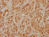 IHC image of CSB-PA013091NA01HU diluted at 1:400 and staining in paraffin-embedded human liver cancer performed on a Leica BondTM system. After dewaxing and hydration, antigen retrieval was mediated by high pressure in a citrate buffer (pH 6.0) . Section was blocked with 10% normal goat serum 30min at RT. Then primary antibody (1% BSA) was incubated at 4°C overnight. The primary is detected by a biotinylated secondary antibody and visualized using an HRP conjugated SP system.