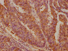 IHC image of CSB-PA013757LA01HU diluted at 1:100 and staining in paraffin-embedded human colon cancer performed on a Leica BondTM system. After dewaxing and hydration, antigen retrieval was mediated by high pressure in a citrate buffer (pH 6.0) . Section was blocked with 10% normal goat serum 30min at RT. Then primary antibody (1% BSA) was incubated at 4°C overnight. The primary is detected by a biotinylated secondary antibody and visualized using an HRP conjugated SP system.