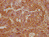 IHC image of CSB-PA022758LA01HU diluted at 1:500 and staining in paraffin-embedded human colon cancer performed on a Leica BondTM system. After dewaxing and hydration, antigen retrieval was mediated by high pressure in a citrate buffer (pH 6.0) . Section was blocked with 10% normal goat serum 30min at RT. Then primary antibody (1% BSA) was incubated at 4°C overnight. The primary is detected by a biotinylated secondary antibody and visualized using an HRP conjugated SP system.