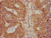 IHC image of CSB-PA839344LA01HU diluted at 1:100 and staining in paraffin-embedded human colon cancer performed on a Leica BondTM system. After dewaxing and hydration, antigen retrieval was mediated by high pressure in a citrate buffer (pH 6.0) . Section was blocked with 10% normal goat serum 30min at RT. Then primary antibody (1% BSA) was incubated at 4°C overnight. The primary is detected by a biotinylated secondary antibody and visualized using an HRP conjugated SP system.