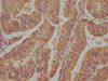 IHC image of CSB-PA007569LA01HU diluted at 1:100 and staining in paraffin-embedded human endometrial cancer performed on a Leica BondTM system. After dewaxing and hydration, antigen retrieval was mediated by high pressure in a citrate buffer (pH 6.0) . Section was blocked with 10% normal goat serum 30min at RT. Then primary antibody (1% BSA) was incubated at 4°C overnight. The primary is detected by a biotinylated secondary antibody and visualized using an HRP conjugated SP system.