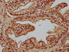 IHC image of CSB-PA859524LA01HU diluted at 1:100 and staining in paraffin-embedded human prostate cancer performed on a Leica BondTM system. After dewaxing and hydration, antigen retrieval was mediated by high pressure in a citrate buffer (pH 6.0) . Section was blocked with 10% normal goat serum 30min at RT. Then primary antibody (1% BSA) was incubated at 4°C overnight. The primary is detected by a biotinylated secondary antibody and visualized using an HRP conjugated SP system.