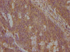 IHC image of CSB-PA892354NA01HU diluted at 1:100 and staining in paraffin-embedded human colon cancer performed on a Leica BondTM system. After dewaxing and hydration, antigen retrieval was mediated by high pressure in a citrate buffer (pH 6.0) . Section was blocked with 10% normal goat serum 30min at RT. Then primary antibody (1% BSA) was incubated at 4°C overnight. The primary is detected by a biotinylated secondary antibody and visualized using an HRP conjugated SP system.