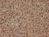 IHC image of CSB-PA897097HA01HU diluted at 1:100 and staining in paraffin-embedded human glioma cancer performed on a Leica BondTM system. After dewaxing and hydration, antigen retrieval was mediated by high pressure in a citrate buffer (pH 6.0) . Section was blocked with 10% normal goat serum 30min at RT. Then primary antibody (1% BSA) was incubated at 4°C overnight. The primary is detected by a biotinylated secondary antibody and visualized using an HRP conjugated SP system.