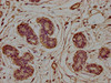 IHC image of CSB-PA005484LA01HU diluted at 1:100 and staining in paraffin-embedded human breast cancer performed on a Leica BondTM system. After dewaxing and hydration, antigen retrieval was mediated by high pressure in a citrate buffer (pH 6.0) . Section was blocked with 10% normal goat serum 30min at RT. Then primary antibody (1% BSA) was incubated at 4°C overnight. The primary is detected by a biotinylated secondary antibody and visualized using an HRP conjugated SP system.