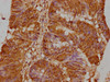 IHC image of CSB-PA009600LA01HU diluted at 1:500 and staining in paraffin-embedded human colon cancer performed on a Leica BondTM system. After dewaxing and hydration, antigen retrieval was mediated by high pressure in a citrate buffer (pH 6.0) . Section was blocked with 10% normal goat serum 30min at RT. Then primary antibody (1% BSA) was incubated at 4°C overnight. The primary is detected by a biotinylated secondary antibody and visualized using an HRP conjugated SP system.