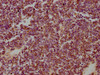 IHC image of CSB-PA010847LA01HU diluted at 1:300 and staining in paraffin-embedded human lung cancer performed on a Leica BondTM system. After dewaxing and hydration, antigen retrieval was mediated by high pressure in a citrate buffer (pH 6.0) . Section was blocked with 10% normal goat serum 30min at RT. Then primary antibody (1% BSA) was incubated at 4°C overnight. The primary is detected by a biotinylated secondary antibody and visualized using an HRP conjugated SP system.