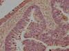 IHC image of CSB-PA012943LA01HU diluted at 1:100 and staining in paraffin-embedded human ovarian cancer performed on a Leica BondTM system. After dewaxing and hydration, antigen retrieval was mediated by high pressure in a citrate buffer (pH 6.0) . Section was blocked with 10% normal goat serum 30min at RT. Then primary antibody (1% BSA) was incubated at 4°C overnight. The primary is detected by a biotinylated secondary antibody and visualized using an HRP conjugated SP system.