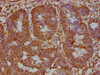 IHC image of CSB-PA017336OA01HU diluted at 1:200 and staining in paraffin-embedded human colon cancer performed on a Leica BondTM system. After dewaxing and hydration, antigen retrieval was mediated by high pressure in a citrate buffer (pH 6.0) . Section was blocked with 10% normal goat serum 30min at RT. Then primary antibody (1% BSA) was incubated at 4°C overnight. The primary is detected by a biotinylated secondary antibody and visualized using an HRP conjugated SP system.