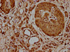 IHC image of CSB-PA357302LA01HU diluted at 1:700 and staining in paraffin-embedded human pancreatic cancer performed on a Leica BondTM system. After dewaxing and hydration, antigen retrieval was mediated by high pressure in a citrate buffer (pH 6.0) . Section was blocked with 10% normal goat serum 30min at RT. Then primary antibody (1% BSA) was incubated at 4°C overnight. The primary is detected by a biotinylated secondary antibody and visualized using an HRP conjugated SP system.