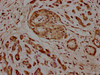 IHC image of CSB-PA883440LA01HU diluted at 1:100 and staining in paraffin-embedded human pancreatic cancer performed on a Leica BondTM system. After dewaxing and hydration, antigen retrieval was mediated by high pressure in a citrate buffer (pH 6.0) . Section was blocked with 10% normal goat serum 30min at RT. Then primary antibody (1% BSA) was incubated at 4°C overnight. The primary is detected by a biotinylated secondary antibody and visualized using an HRP conjugated SP system.