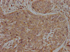 IHC image of CSB-PA011755LA01HU diluted at 1:200 and staining in paraffin-embedded human cervical cancer performed on a Leica BondTM system. After dewaxing and hydration, antigen retrieval was mediated by high pressure in a citrate buffer (pH 6.0) . Section was blocked with 10% normal goat serum 30min at RT. Then primary antibody (1% BSA) was incubated at 4°C overnight. The primary is detected by a biotinylated secondary antibody and visualized using an HRP conjugated SP system.