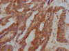 IHC image of CSB-PA023433LA01HU diluted at 1:1000 and staining in paraffin-embedded human colon cancer performed on a Leica BondTM system. After dewaxing and hydration, antigen retrieval was mediated by high pressure in a citrate buffer (pH 6.0) . Section was blocked with 10% normal goat serum 30min at RT. Then primary antibody (1% BSA) was incubated at 4°C overnight. The primary is detected by a Goat anti-rabbit IgG polymer labeled by HRP and visualized using 0.05% DAB.