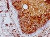 IHC image of CSB-PA04837A0Rb diluted at 1:100 and staining in paraffin-embedded human breast cancer performed on a Leica BondTM system. After dewaxing and hydration, antigen retrieval was mediated by high pressure in a citrate buffer (pH 6.0) . Section was blocked with 10% normal goat serum 30min at RT. Then primary antibody (1% BSA) was incubated at 4°C overnight. The primary is detected by a Goat anti-rabbit IgG labeled by HRP and visualized using 0.05% DAB.